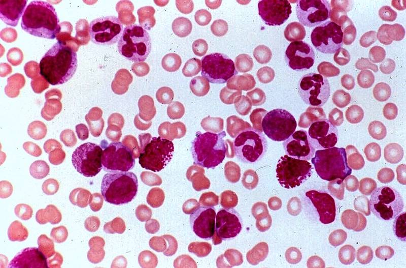 Treatment of Recombinant Human Thrombopoietin in Thrombocytopenia after Chemotherapy of Acute Leukemia